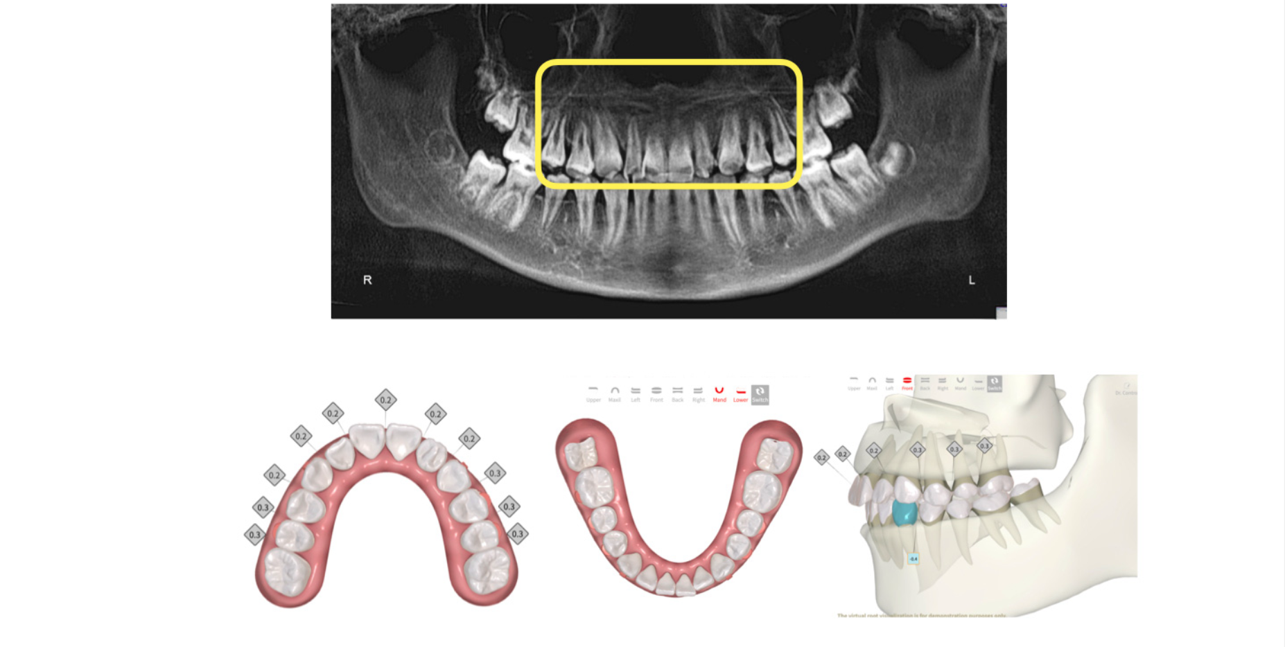 Alineadores ortodóncicos: Perspectivas actuales para el consultorio de ortodoncia moderno