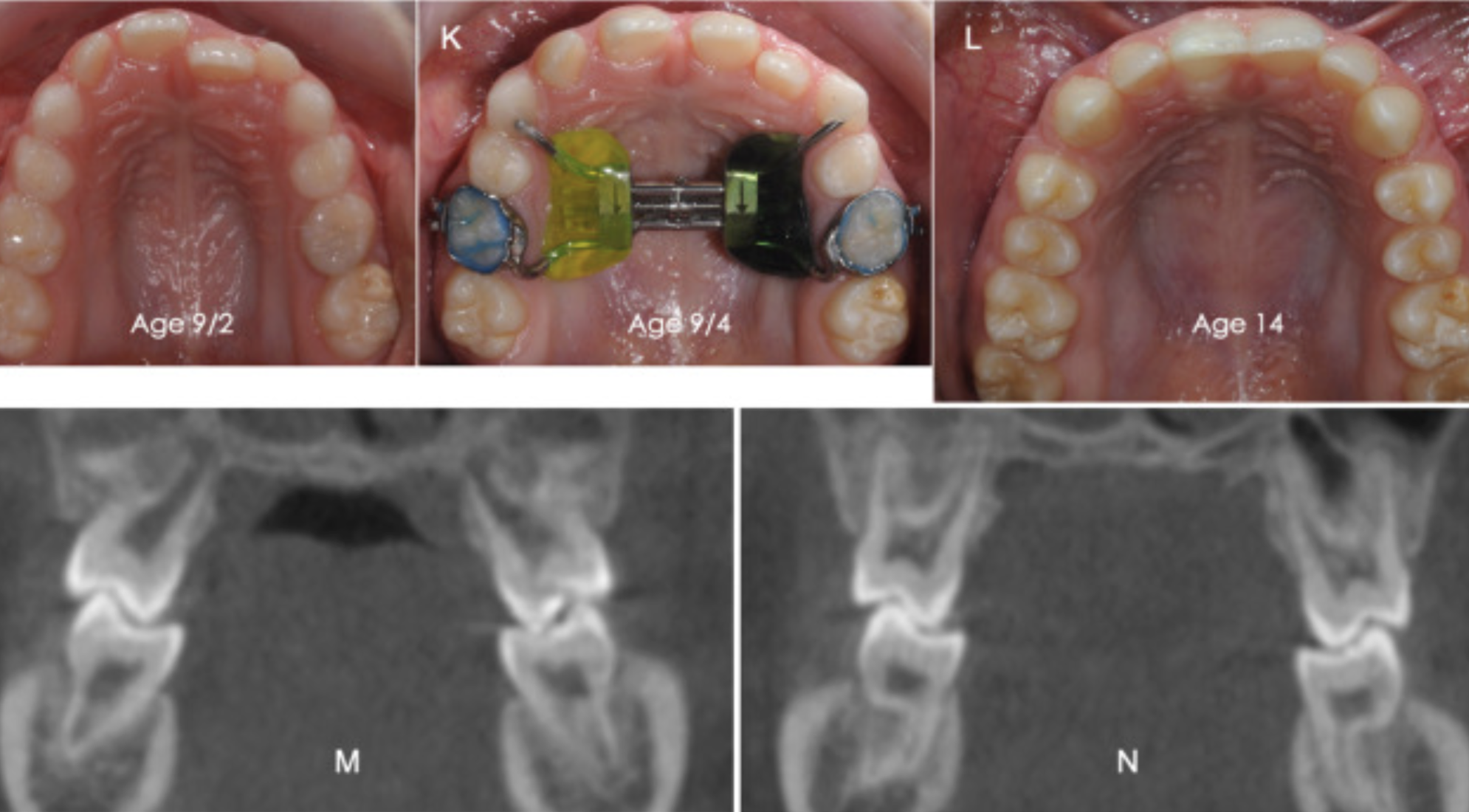 Fundamentos  y recomendaciones clínicas de la corrección de la mordida cruzada en dentición mixta.