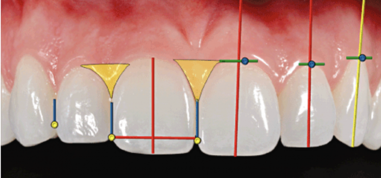 Papel de la Microestética en Ortodoncia