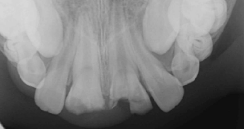 Tratamiento de  intrusión concomitante y lesión complicada por fractura de la corona y la raíz de incisivos centrales maxilares en un niño