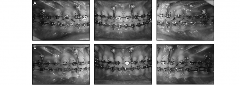 Extrusión con anclaje esquelético para mejorar la visualización de los incisivos maxilares en un caso de deficiencia maxilar vertical