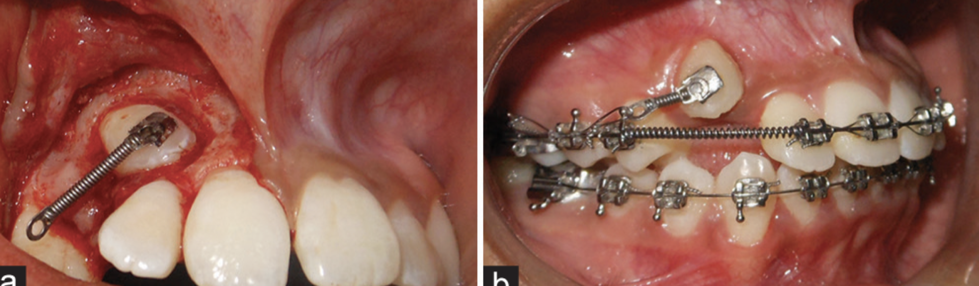 BDR CCLXXV: Resorte W para manejo de diente impactado.