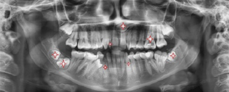 Enfoque multidisciplinar para el tratamiento de la agenesia dentaria múltiple, retención e impactación