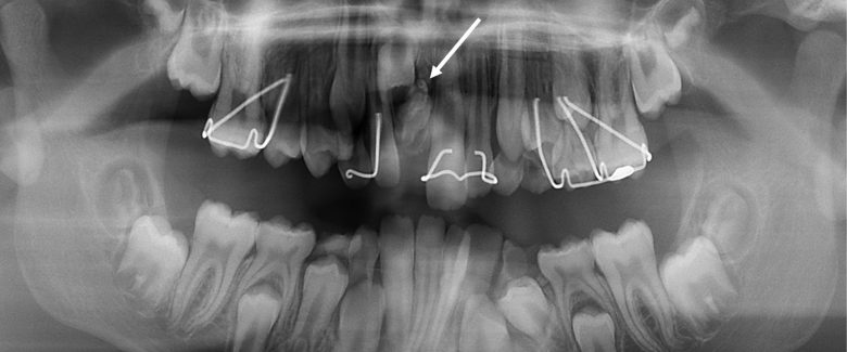 Patología oral en Ortodoncia: Patologías esqueletales de los maxilares