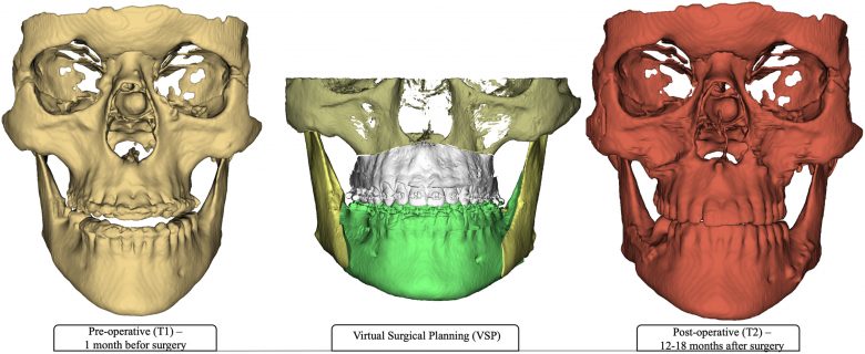 Mejorando de la estabilidad esquelética y la corrección de Clase III mediante la participación activa del ortodoncista en la planificación quirúrgica virtual
